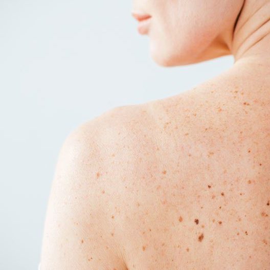 Tumori della pelle: come riconoscere i melanomi e come prevenirli.